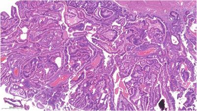 Traditional Serrated Adenoma of the Gallbladder, a Case Report